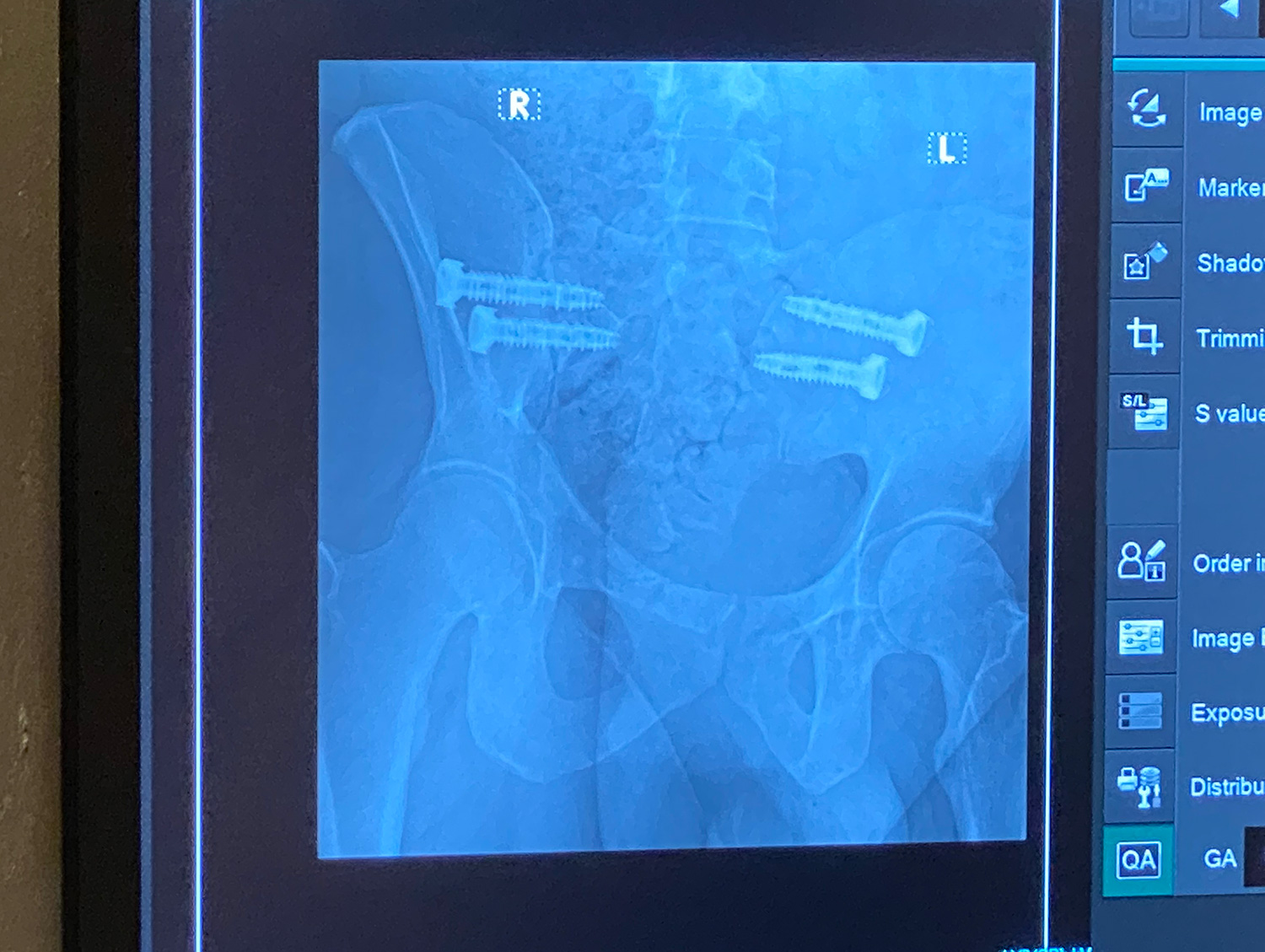 SI Joint Fusion X-Ray